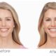 The Role of Botox in Modern-Day Aesthetics and Medicine